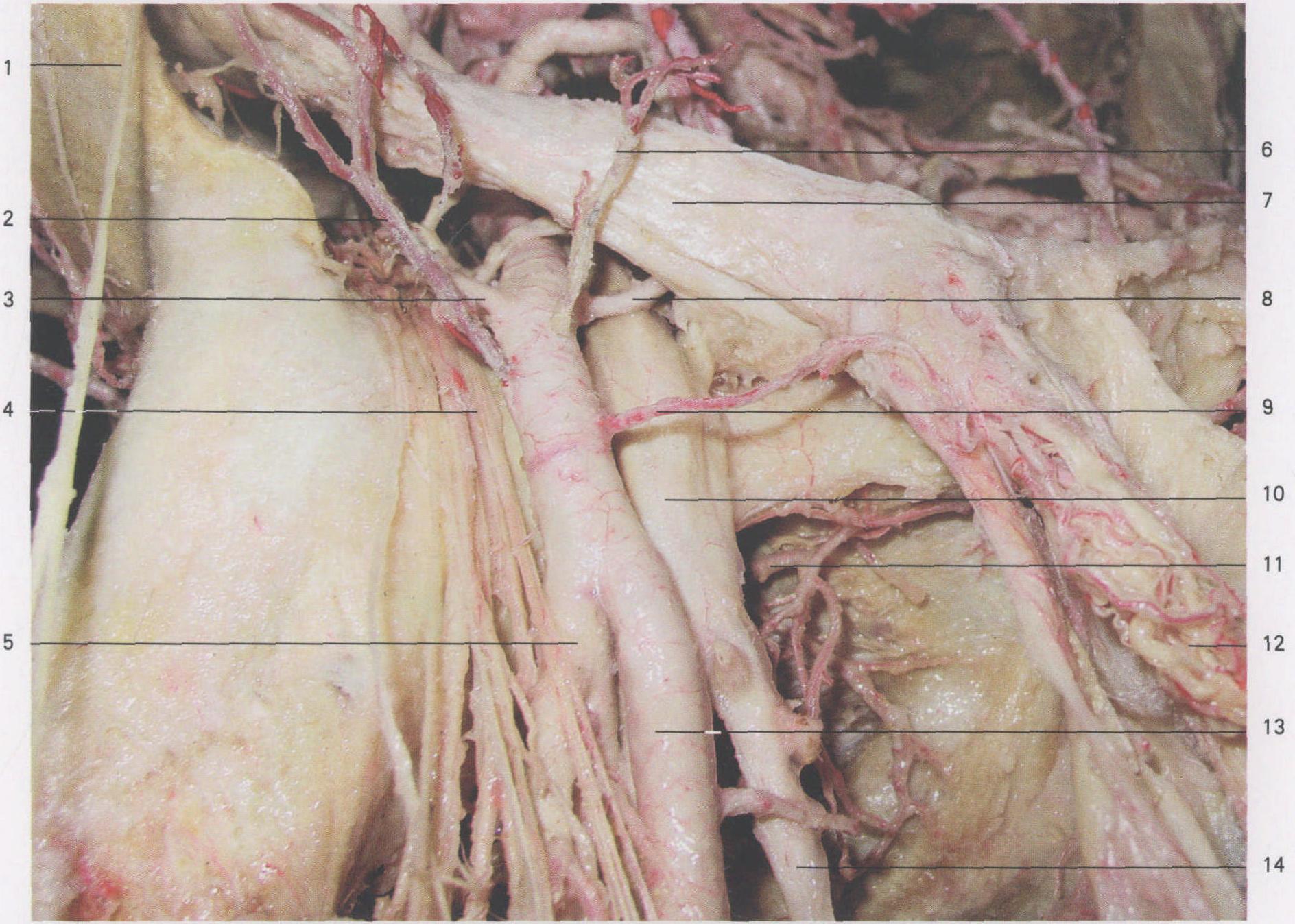 主动脉夹层（医学影像图片） - 知乎
